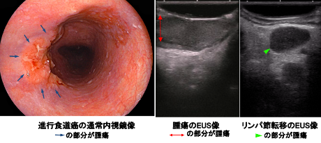図7：進行食道がんの内視鏡像と超音波内視鏡（EUS）像