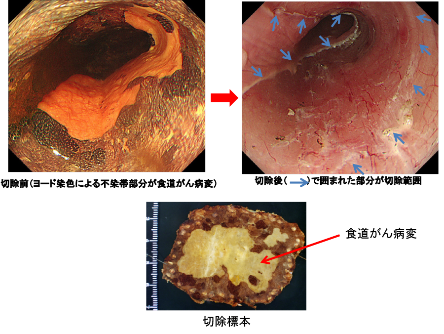 図20：内視鏡的粘膜下層剥離術（ESD)による食道がんの内視鏡的治療