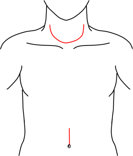 図25：頸部食道がん手術の皮膚切開（赤線）