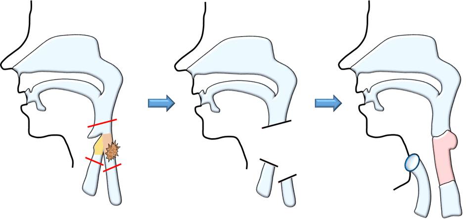 図29：喉頭合併切除する場合の模式図