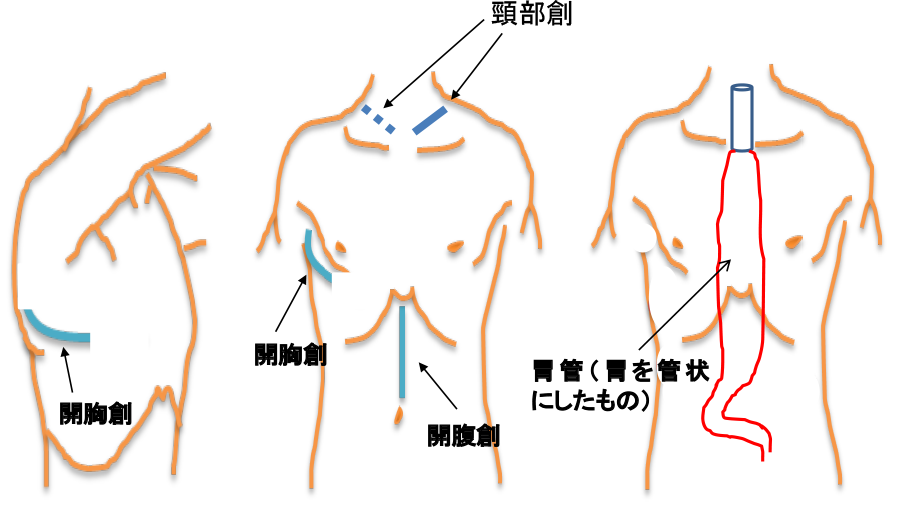 図30：開胸・開腹手術の創部