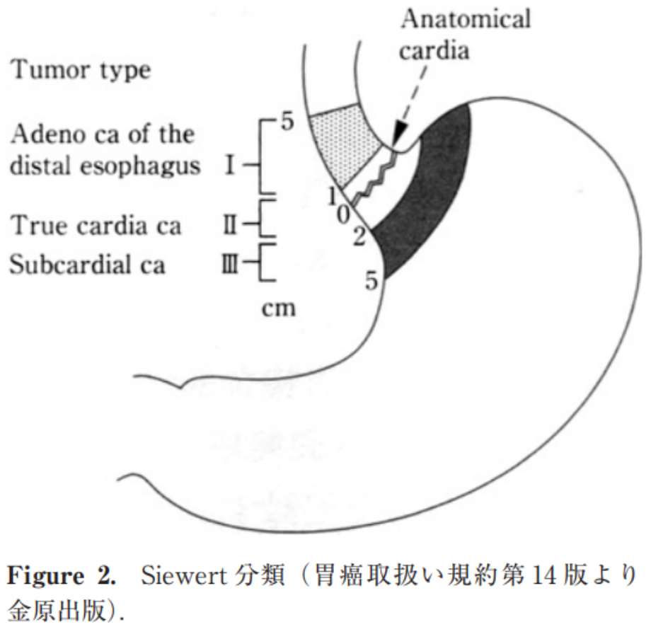図35：Siewertの定義（「胃癌取扱い規約15版」金原出版より）