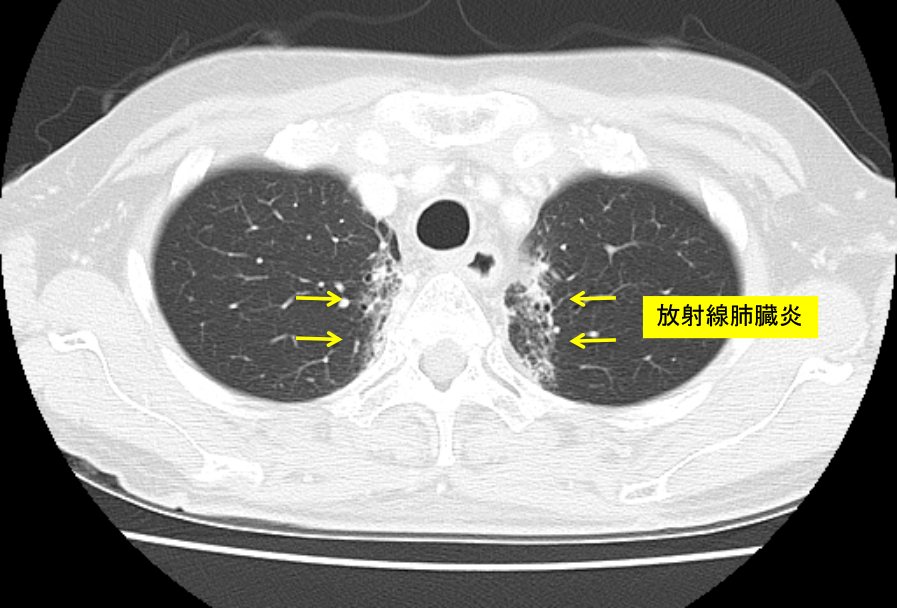 図39：放射線肺臓炎（CT画像）