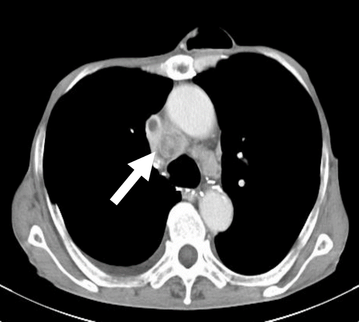 図42：食道がん術後のリンパ節再発（CT画像）