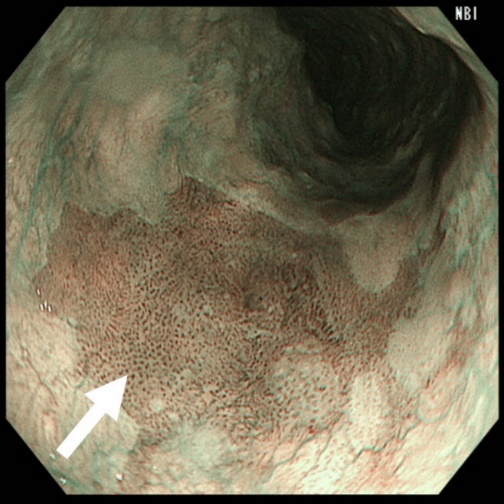 図43：食道がん内視鏡治療後の瘢痕近くに発見された早期食道がん