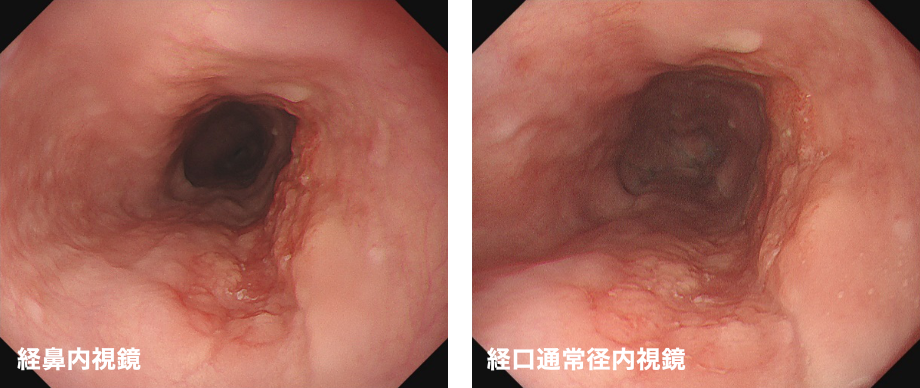 経鼻内視鏡、経口通常径内視鏡
