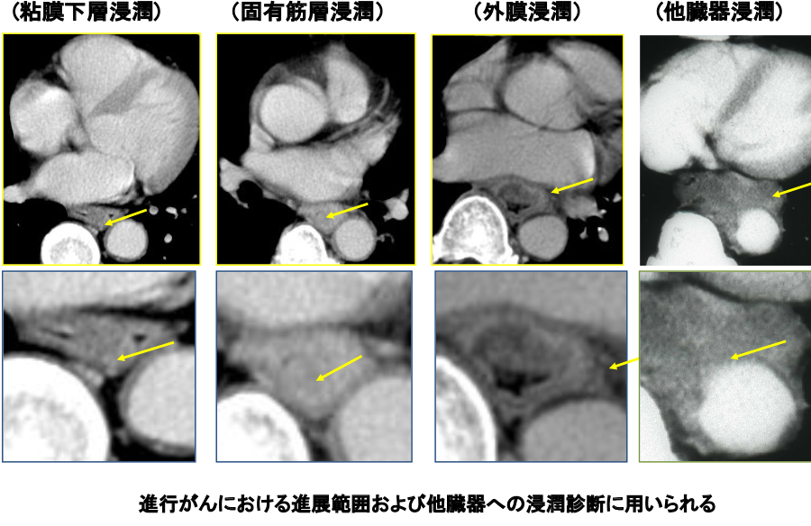 図9：CTによる壁深達度診断