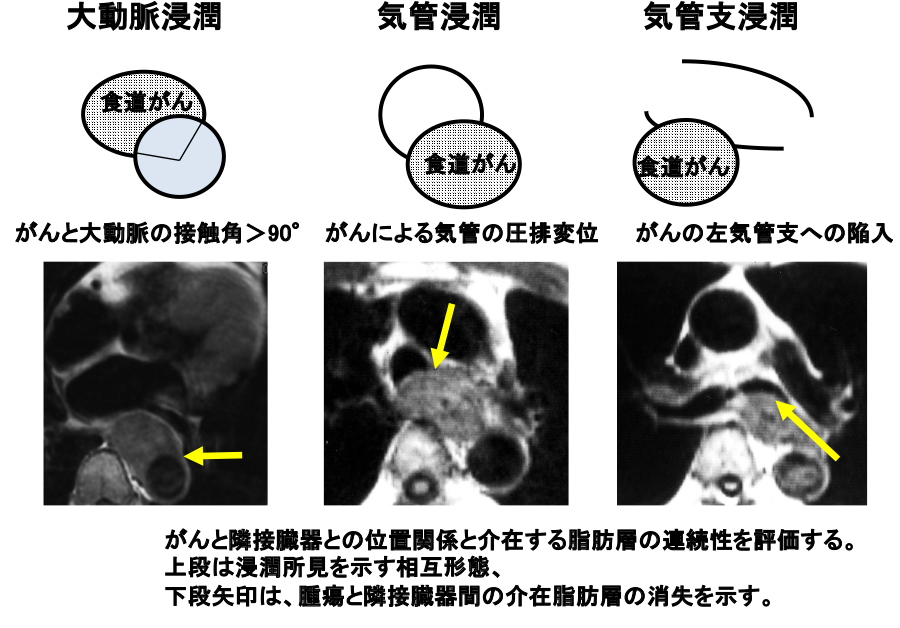 図10：MRIによる他臓器浸潤診断
