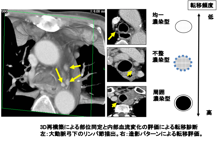 図11：造影MD（multi-detector）CTによるリンパ節診断