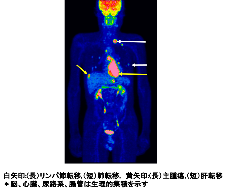 図12：全身FDG（fluorodeoxyglucose）-PETによるリンパ節転移、遠隔臓器転移診断