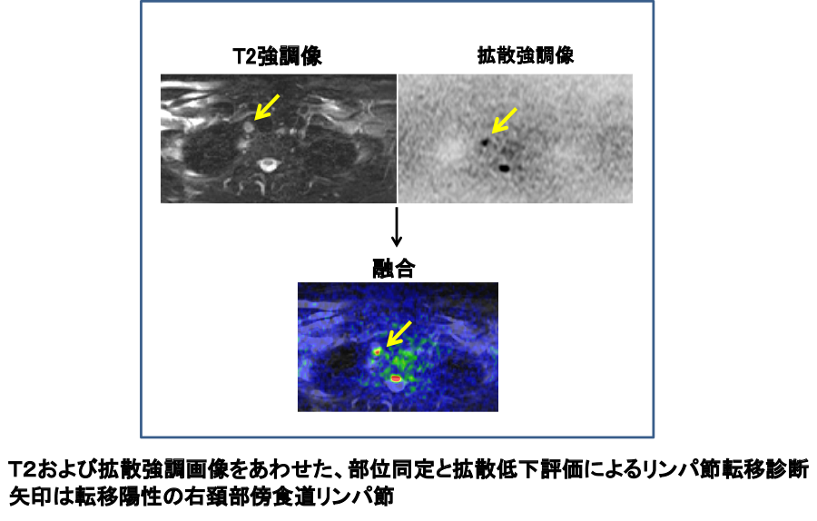 図13：MRIによる転移リンパ節診断