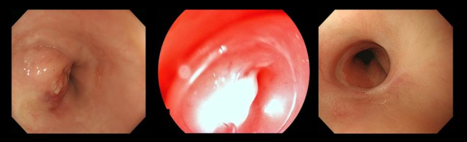 図23：光線力学療法（PDT：Photodynamic Therapy）による食道がんの治療　左：化学放射線療法後再発病変、中央：光線力学療法、レーザー光照射中、右：治療から2年後再発なく経過中