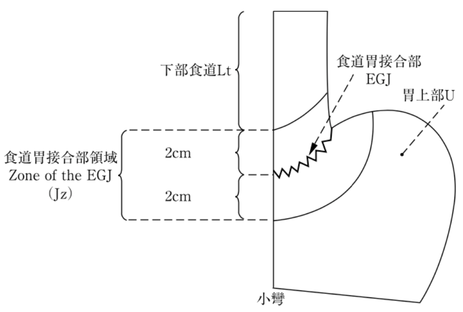 図33：食道胃接合部領域の定義と名称（西の定義）（「胃がん取扱い規約15版」より改変転載