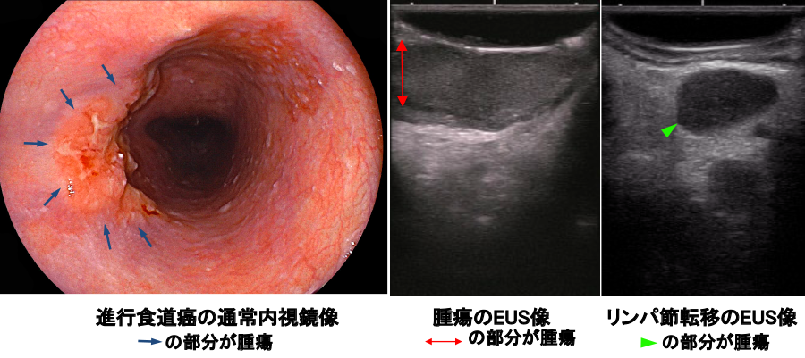 図6：進行食道がんの内視鏡像と超音波内視鏡（EUS)像