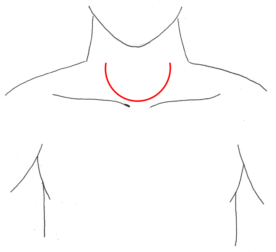 図20：頸部食道がん手術の皮膚切開（赤線）