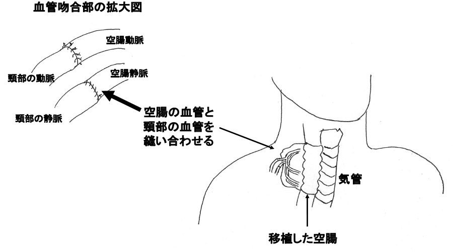 図22：遊離空腸移植術