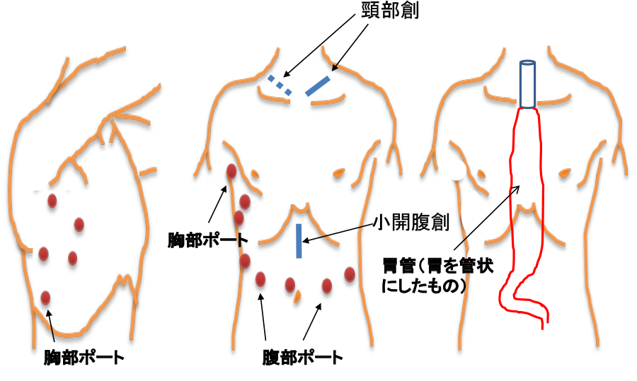 図25：胸部食道がんに対する胸腔鏡下手術および腹腔鏡下手術