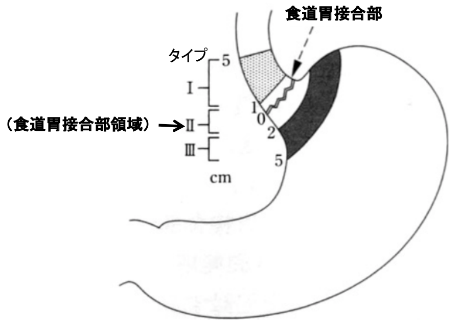 図28：ジーベルト（Siewert)の定義による食道胃接合部