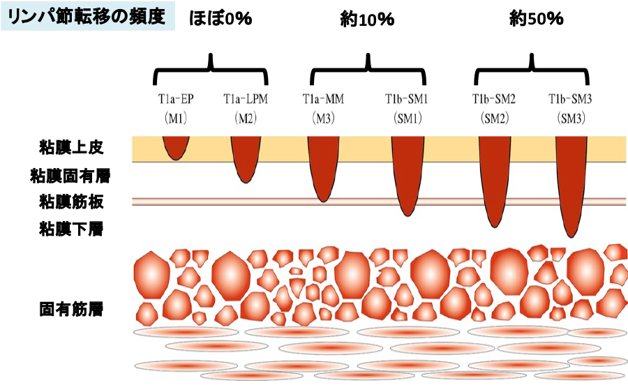 が 進行 大腸 速度 ん